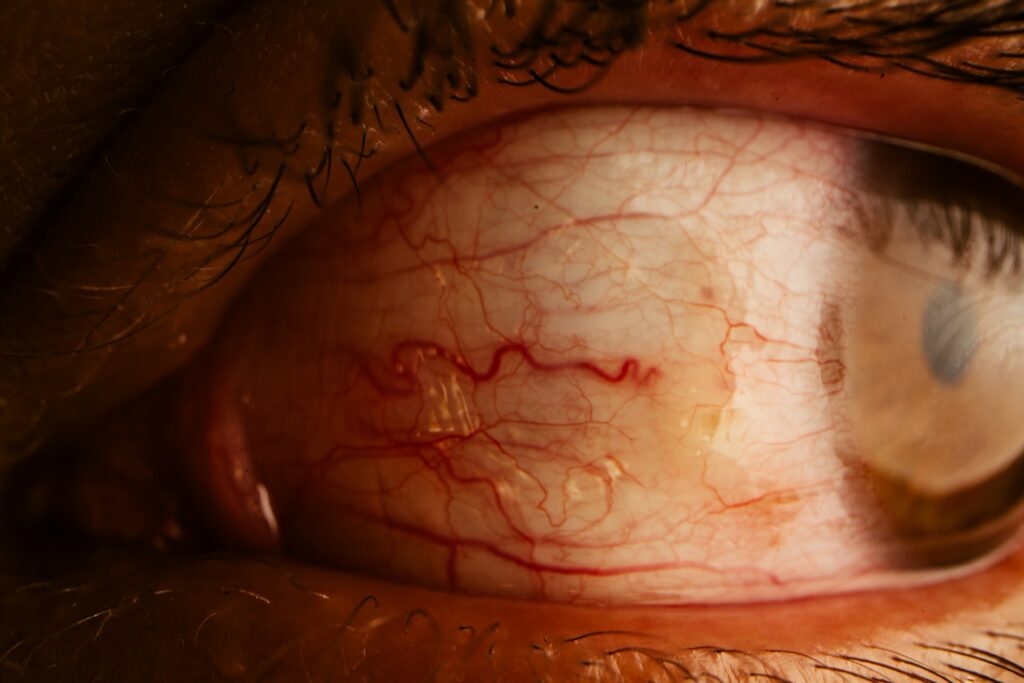 Bloodshot human eye