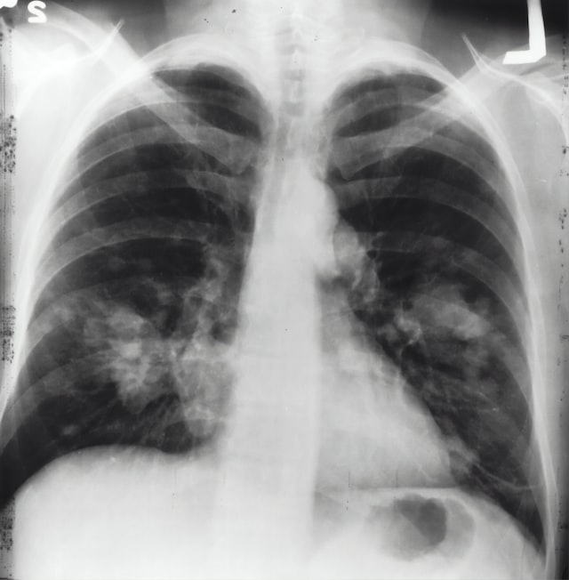 Xray of the lungs